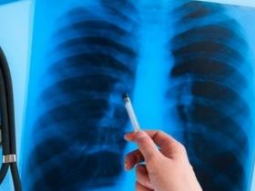 Туберкулез дененің кез келген жерінде болады